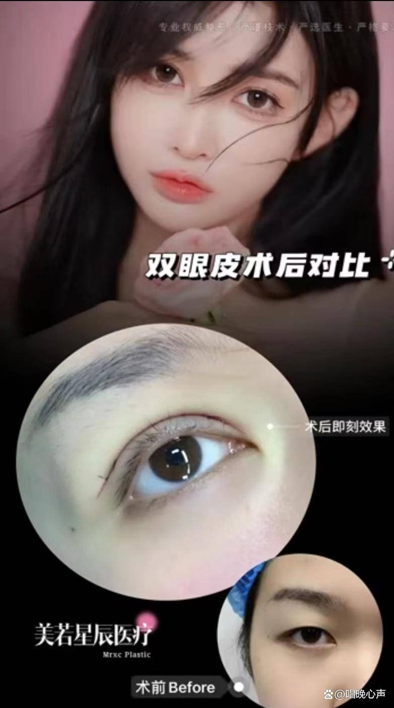 美版苹果好还是韩版的好:上海美若星辰门诊：双眼皮埋线好还是割好